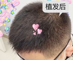 -大麦微针植发全国连锁