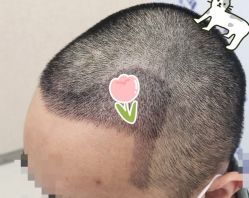 -大麦微针植发全国连锁