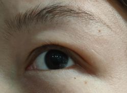 体验后-成都西区医院整形美容