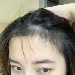 -碧莲盛·不剃发植发