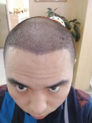 点击看大图 -大麦微针植发丨全国连锁