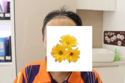 -大麦微针植发丨全国连锁