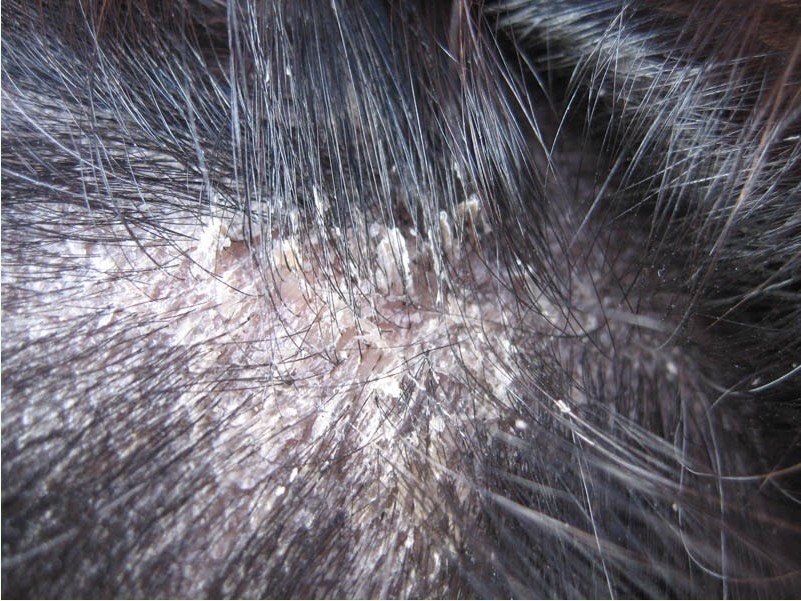 头皮上有白斑红白而且头皮屑特别多