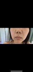 体验后-苏州维多利亚美容医院