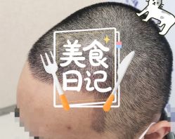 -大麦微针植发全国连锁