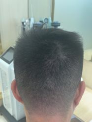 -碧莲盛·不剃发植发