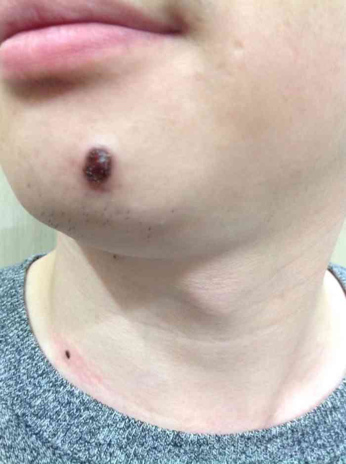 玉面坊专业祛大痣去痣取痣点痣祛斑祛疣(上海徐汇店)-"整体来说很满意