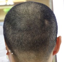 -大麦微针植发丨全国连锁