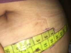 -肥三针腧穴瘦身馆