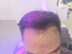 体验后-大麦微针植发全国连锁