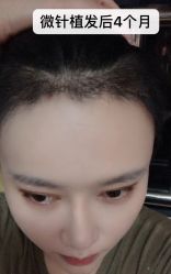 点击看大图 -大麦微针植发全国连锁