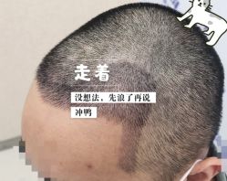 -大麦微针植发全国连锁