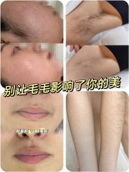 -薇兰专业脱毛连锁机构