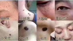-美人痣全国连锁