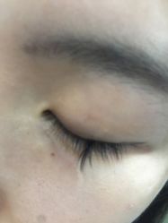 体验后-郡艺医疗美容·微整·眼鼻吸脂