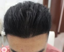 -大麦微针植发丨全国连锁