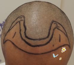 -大麦微针植发全国连锁