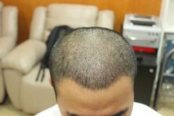 点击看大图 -大麦微针植发丨全国连锁