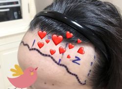 -大麦微针植发全国连锁