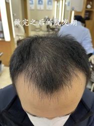 -大麦微针植发全国连锁