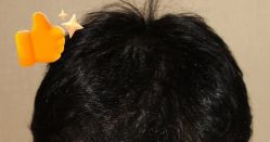 -大麦微针植发丨全国连锁