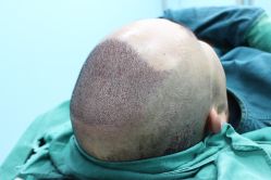 点击看大图 -大麦微针植发丨全国连锁