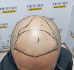 -大麦微针植发丨全国连锁