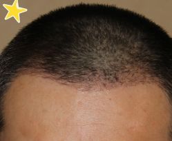 -大麦微针植发丨全国连锁