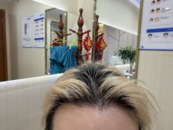 -碧莲盛·不剃发植发