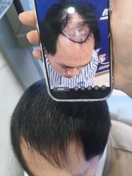 -碧莲盛·不剃发植发