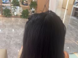 -碧莲盛·不剃发植发