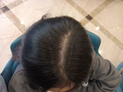 -碧莲盛·不剃发植发