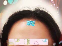 -大麦微针植发全国连锁