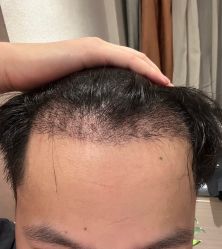 -大麦微针植发全国连锁