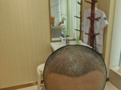 -碧莲盛·不剃发植发