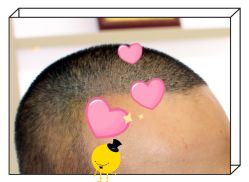 -大麦微针植发全国连锁