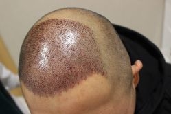 点击看大图 -大麦微针植发丨全国连锁