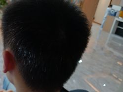 -碧莲盛·不剃发植发
