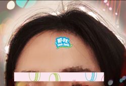 -大麦微针植发全国连锁