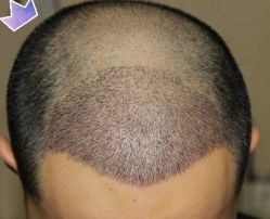 -大麦微针植发丨全国连锁