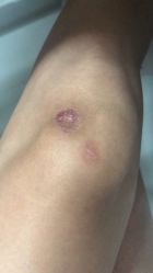 -成都军建医院·疤痕诊疗中心