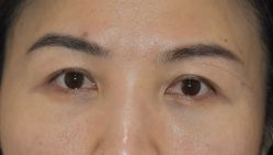 -广州健丽·去眼袋医疗美容机构