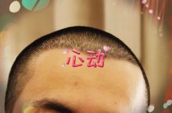 -大麦微针植发全国连锁