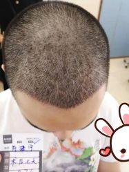 点击看大图 -大麦微针植发丨全国连锁