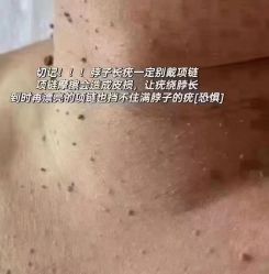 -苗方清颜专业祛痘连锁机构