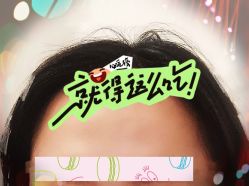 -大麦微针植发全国连锁