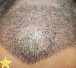 -大麦微针植发丨全国连锁