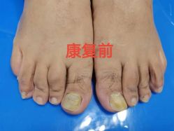 -德哥灰指甲脚气甲沟炎跖疣护理