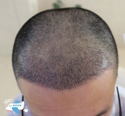 -大麦微针植发丨全国连锁