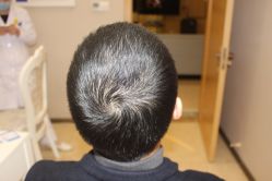 -大麦微针植发丨全国连锁